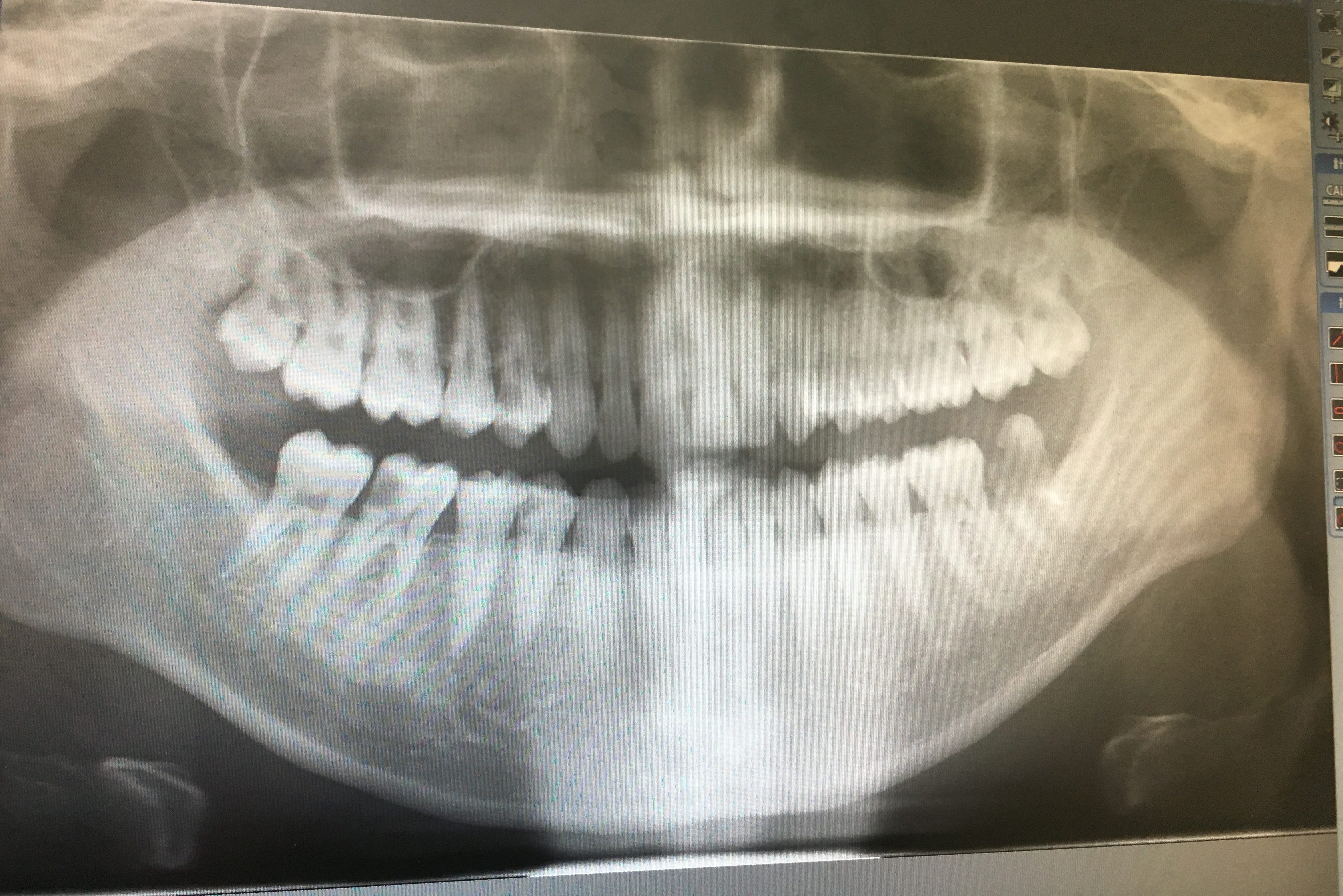虫歯　抜歯